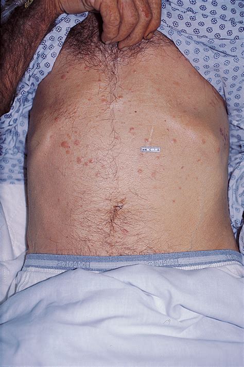 Multiple Subcutaneous Nodules on the Torso and Leg | Dermatology | JAMA ...