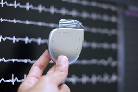 What You Need to Know About the Implantable Cardioverter Defibrillator ...