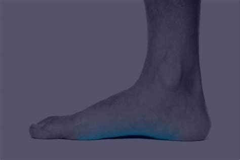 Orthotics for flat feet - Ace Health Centre