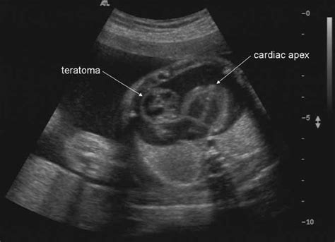 Fetal pericardial teratoma causing cardiac insufficiency: prenatal diagnosis and therapy - Kamil ...