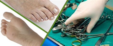 Foot and Ankle Surgery- Canberra's podiatric surgeon