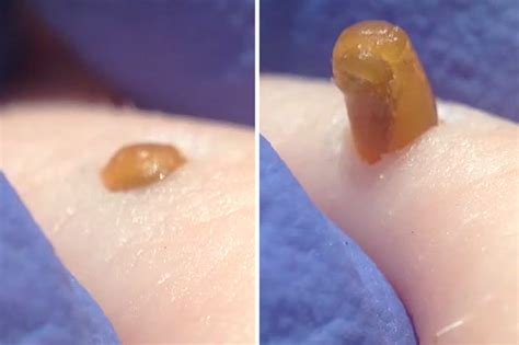 Blackhead explodes in disgusting EXTREME close-up viral video | Daily Star