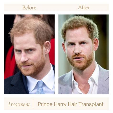 A Look into Prince Harry’s Hair Journey! A Royal Hair Transplant