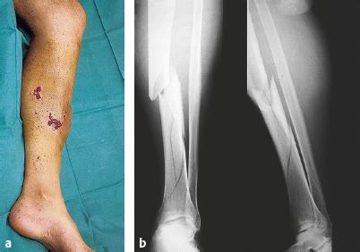 Open Tibia Fracture