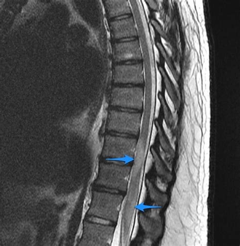 Transverse Myelitis - Causes, Symptoms, Prognosis, Treatment