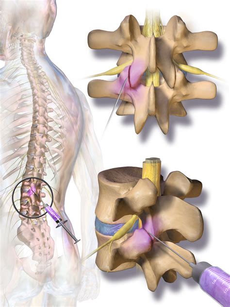 What are Facet Joint Injections and How Do They Help Me? - Integrative Pain & Spine Institute