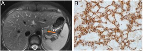 Insulinoma. (A) Pancreatic lesion on T2-weighted MRI image (arrow). (B ...