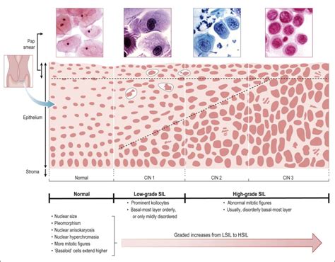 High grade lesion in cervix. High Grade Squamous Intraepithelial Lesion ...