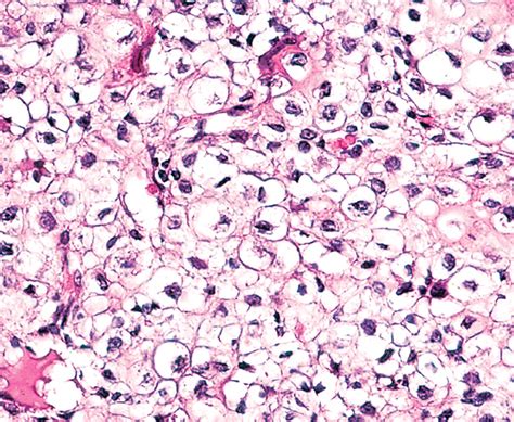 Pathology Outlines - Clear cell