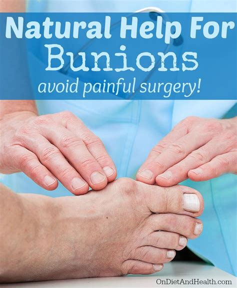 Natural help for #bunions - avoid painful surgery! OnDietAndHealth.com ...