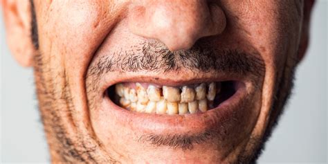 Can having bad teeth affect your overall health? - PostMyMeds