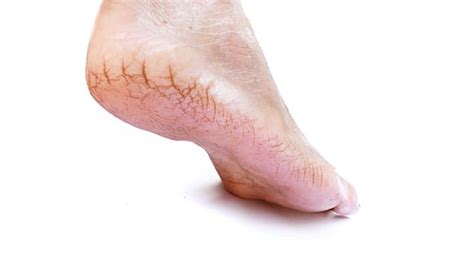 Fissures - L A Foot and Ankle Center