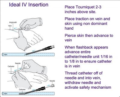 35 IV Therapy Tips & Tricks for Nurses - NurseBuff