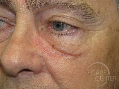 Eyelid Reconstruction 2 - Skin Cancer and Reconstructive Surgery Center