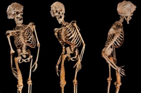 Bone Deformation: What is Proteus Syndrome? - The Rockstar Anthropologist