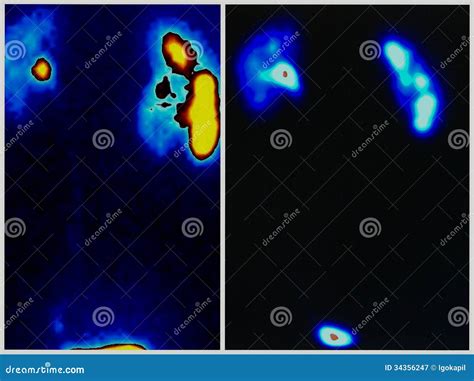 Renal Upj Obstruction After Surgery Royalty Free Stock Photography - Image: 34356247