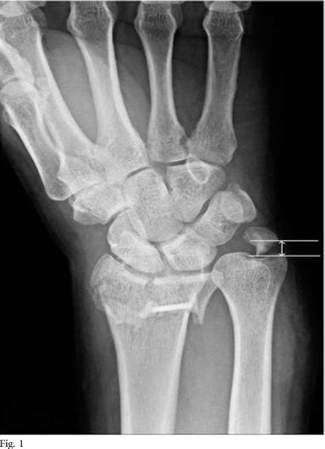 Table II from Should an ulnar styloid fracture be fixed following volar ...