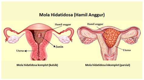 Hamil Anggur Adalah – newstempo