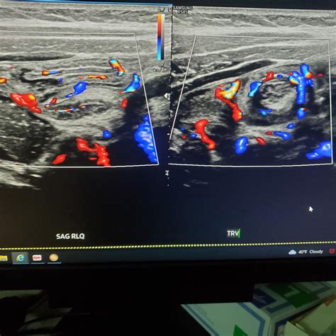 Intussusception and normal appendix on ultrasound : r/Radiology