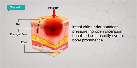 Pressure Ulcer Causes | Stages | Treatment | Axio Biosolutions