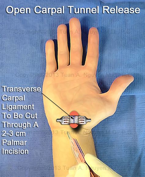 Open Carpal Tunnel Release - Carpal Tunnel Syndrome Portland Hand Surgery