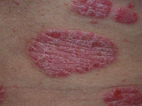 Dermnet Psoriasis