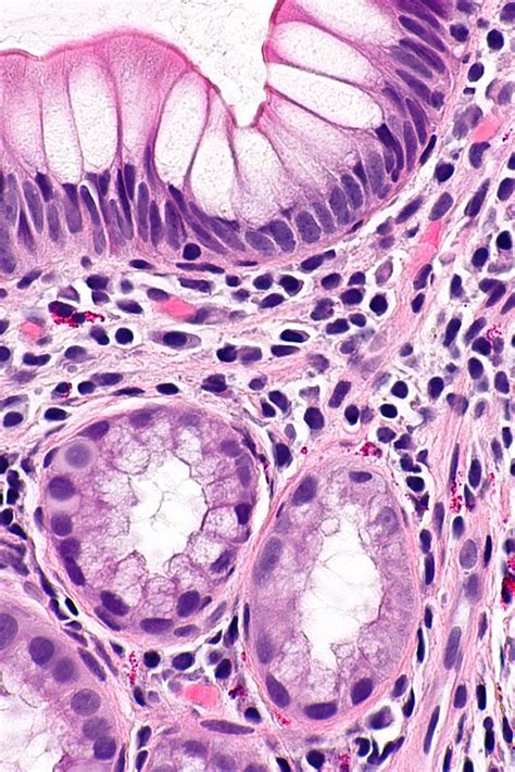 Pseudopyloric mucous glands - Libre Pathology