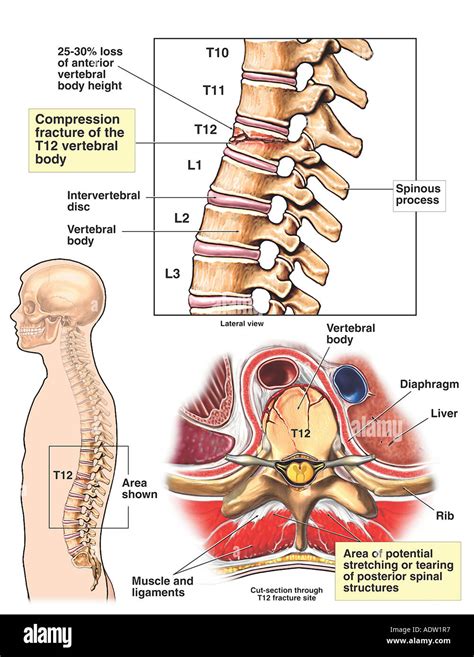 T12 Spinal Cord Injury: What Is The Recovery Outlook? Flint, 40% OFF