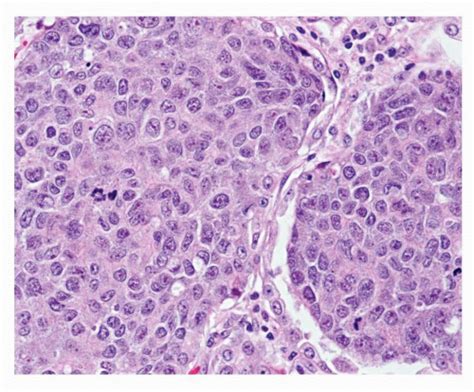 Large Cell Carcinoma | Oncohema Key