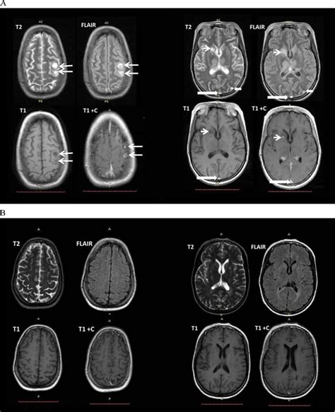 Brain Mri T2 Weighted Sequence Hyperintense Lesions O - vrogue.co