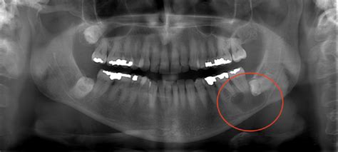 Radicular Cyst of Jaw: A Case Report