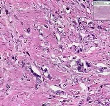 Histopathology Esophagus--Adenocarcinoma - YouTube