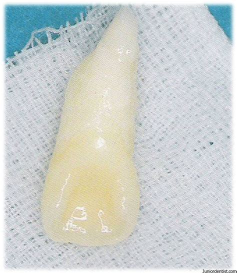 Tooth Avulsion - Exarticulation of Tooth | Treatment and Management