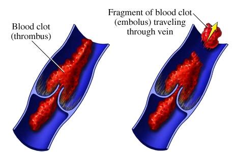 THROMBOSIS & EMBOLISM | NURSING LECTURE