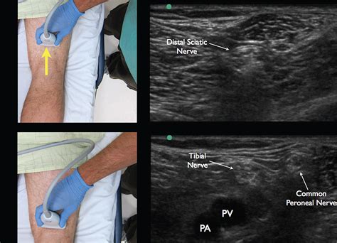 How to Perform Ultrasound-Guided Distal Sciatic Nerve Block in the Popliteal Fossa - Page 2 of 4 ...