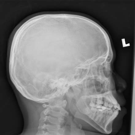 Normal skull radiograph | Radiology Case | Radiopaedia.org