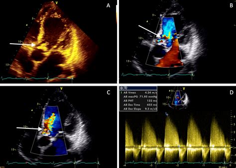 Cureus | Intermittent Recovery of Severe Acute Aortic Regurgitation ...