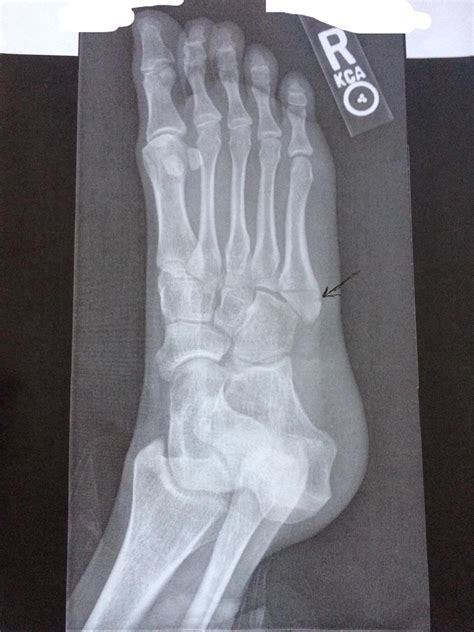 Another pseudo-jones fracture : r/Radiology