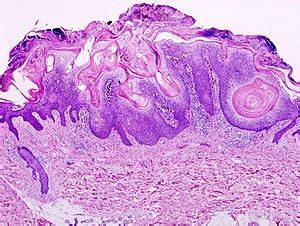 Seborrheic keratosis - Libre Pathology