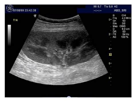 Spectral Doppler ultrasound image shows a tardus parvus waveform in an... | Download Scientific ...