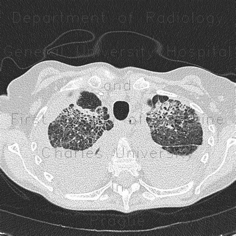 Pleural Thickening From Pneumonia