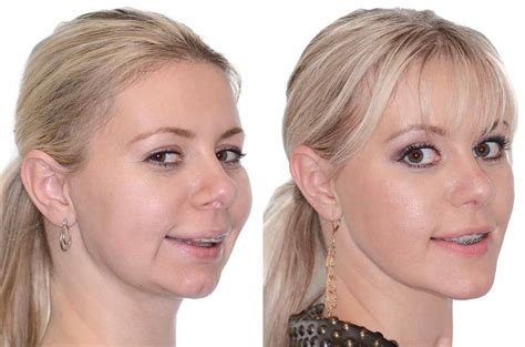 Corrective Jaw Surgery Complete Face Makeover - Corrective Jaw Surgery - Dr. Antipov