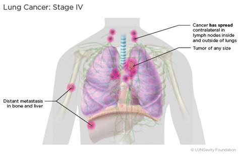 Lung Cancer Staging | LUNGevity Foundation