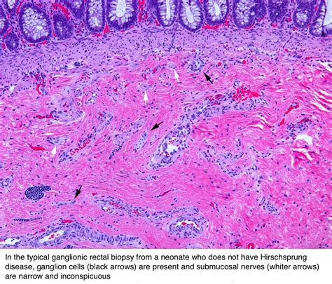 Pathology Outlines - Hirschsprung disease