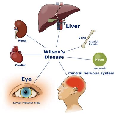 Wilson's Disease: What Are The Causes And Symptoms?