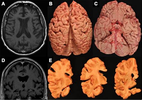 Could Structural MRI Findings Help Detect CTE During Life?