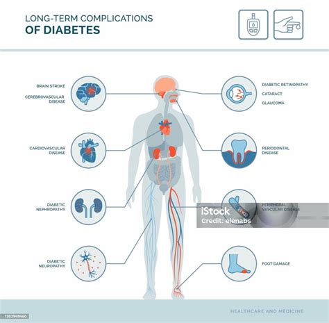 Complications À Long Terme Du Diabète Vecteurs libres de droits et plus ...