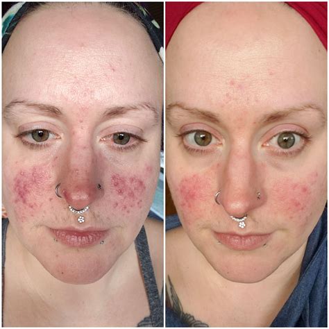 [B&A] Rosacea progress: 36 days of Ivermectin, 2 wks Doxycycline & 1 week Azelaic : r ...