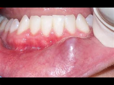 Mucous Cyst Lip Surgical Removal | Sitelip.org