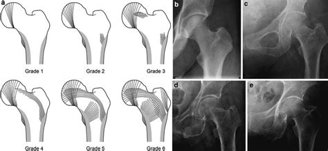 Osteoporosis X Ray Vs Normal